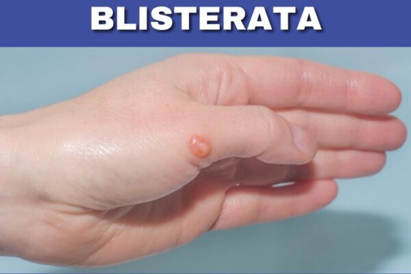 Blisterata